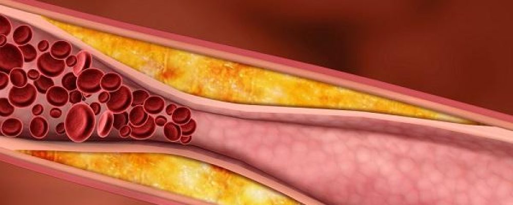 El consumo de cannabis no aumenta el riesgo de aterosclerosis